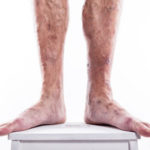 Varicose Veins