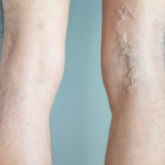 varicose veins