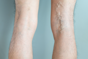 varicose veins