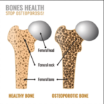 Osteoporosis