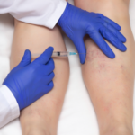 sclerotherapy-west-florida-vein-center-tampa