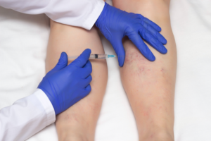 sclerotherapy-west-florida-vein-center-tampa