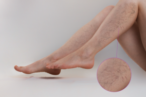 varicose-veins-spider-veins-tampa-cardio