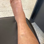 Edema West Florida Vein Center