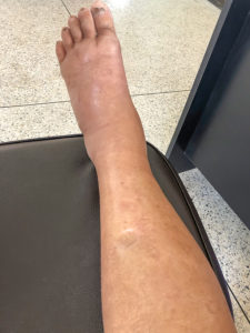 Edema West Florida Vein Center